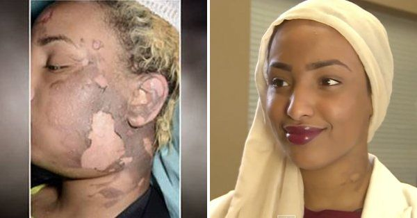 Samira Omar trước và sau khi được Hameed chữa trị